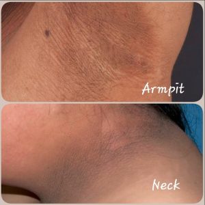 Acanthosis Nigricans